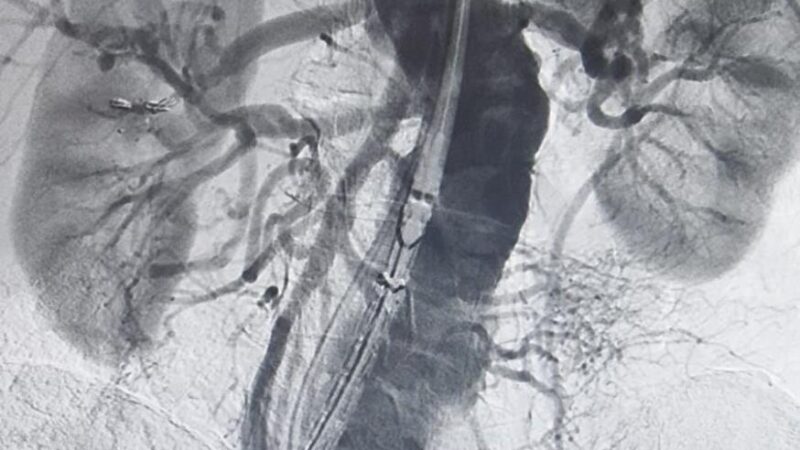 Catheter Saved Saudi man from Abdominal Artery Rupture