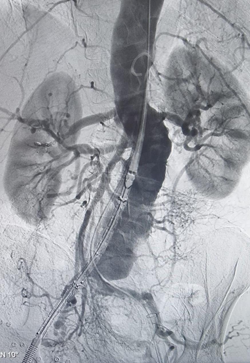 Catheter Saved Saudi man from Abdominal Artery Rupture