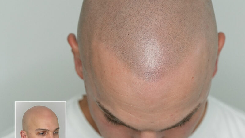 Skalp Revolutionises Hair Loss Treatment with Scalp Micro Pigmentation