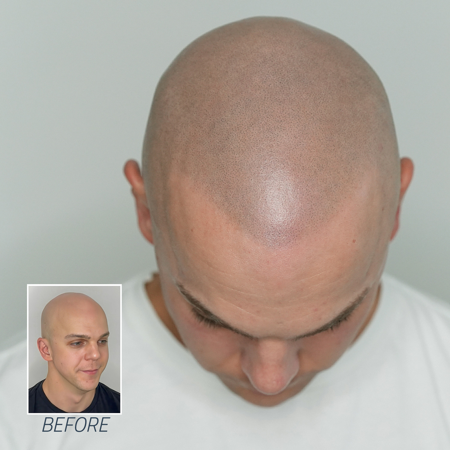 Skalp Revolutionises Hair Loss Treatment with Scalp Micro Pigmentation